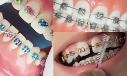 Diş Teli Tedavisi Nedir ve Kimlere Uygulanır