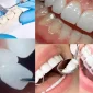 Lamina Nedir? Hangi Durumlarda Uygulanır?